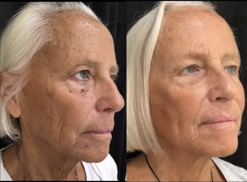 After treatment - Client 2